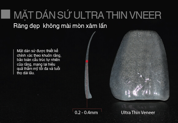 mặt dán sứ ultra thin veneer