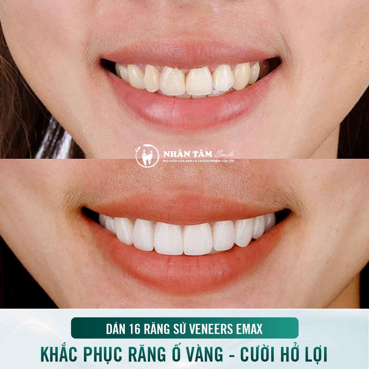 Dán sứ veneer emax tại nhân tâm smile