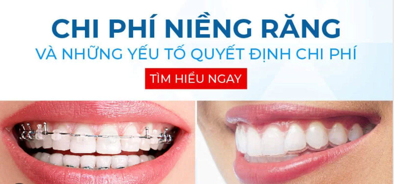 Chi phí niềng răng