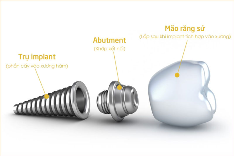 Trụ Implant là gì?