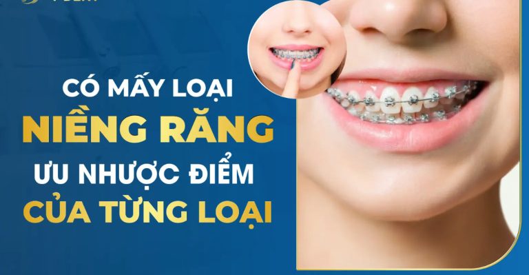 Các loại niềng răng