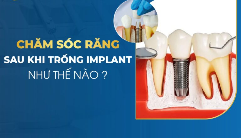 Chăm sóc răng Implant