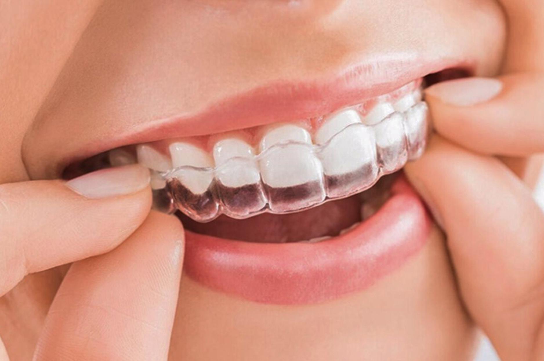 công nghệ niềng răng Invisalign