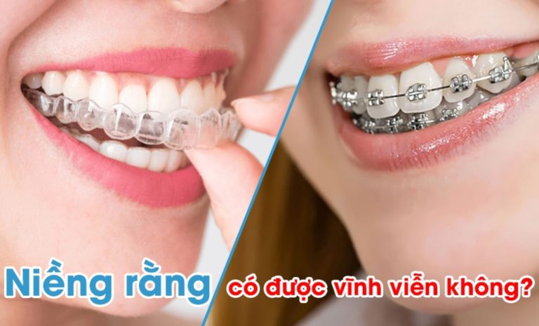 Niềng răng có được vĩnh viễn không