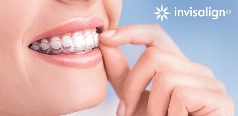 niềng răng invisalign