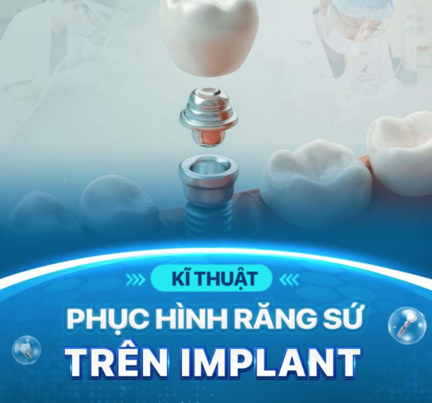 phục hình răng sứ trên Implant