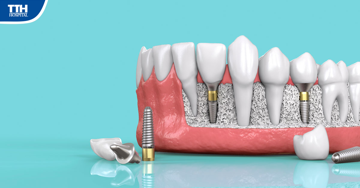 Quy trình làm răng Implant