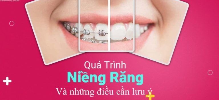 Quy trình niềng răng