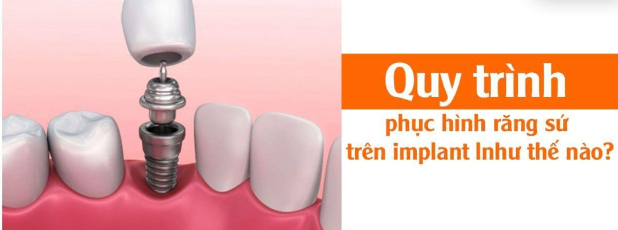 Phục hình răng sứ trên Implant