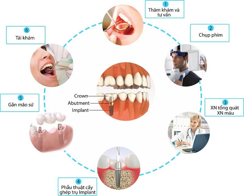 Quy trình làm răng Implant