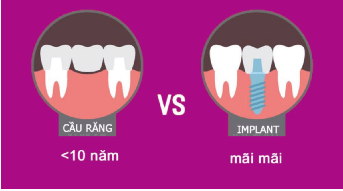 So sánh răng giả và răng Implant