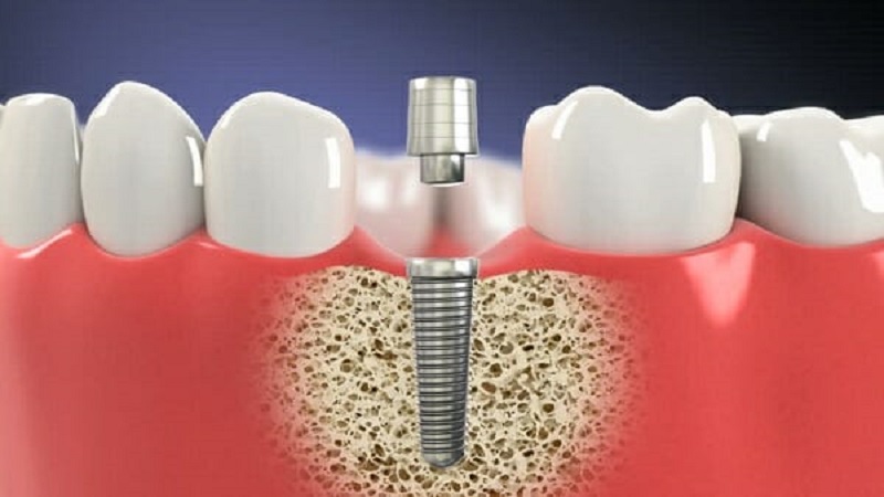 Ưu điểm trụ Implant Dentium Hàn Quốc