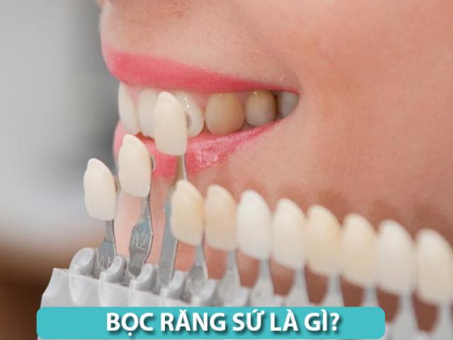 Bọc răng sứ là gì?