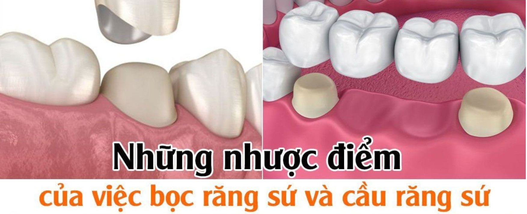 Một số nhược điểm của việc bọc răng sứ