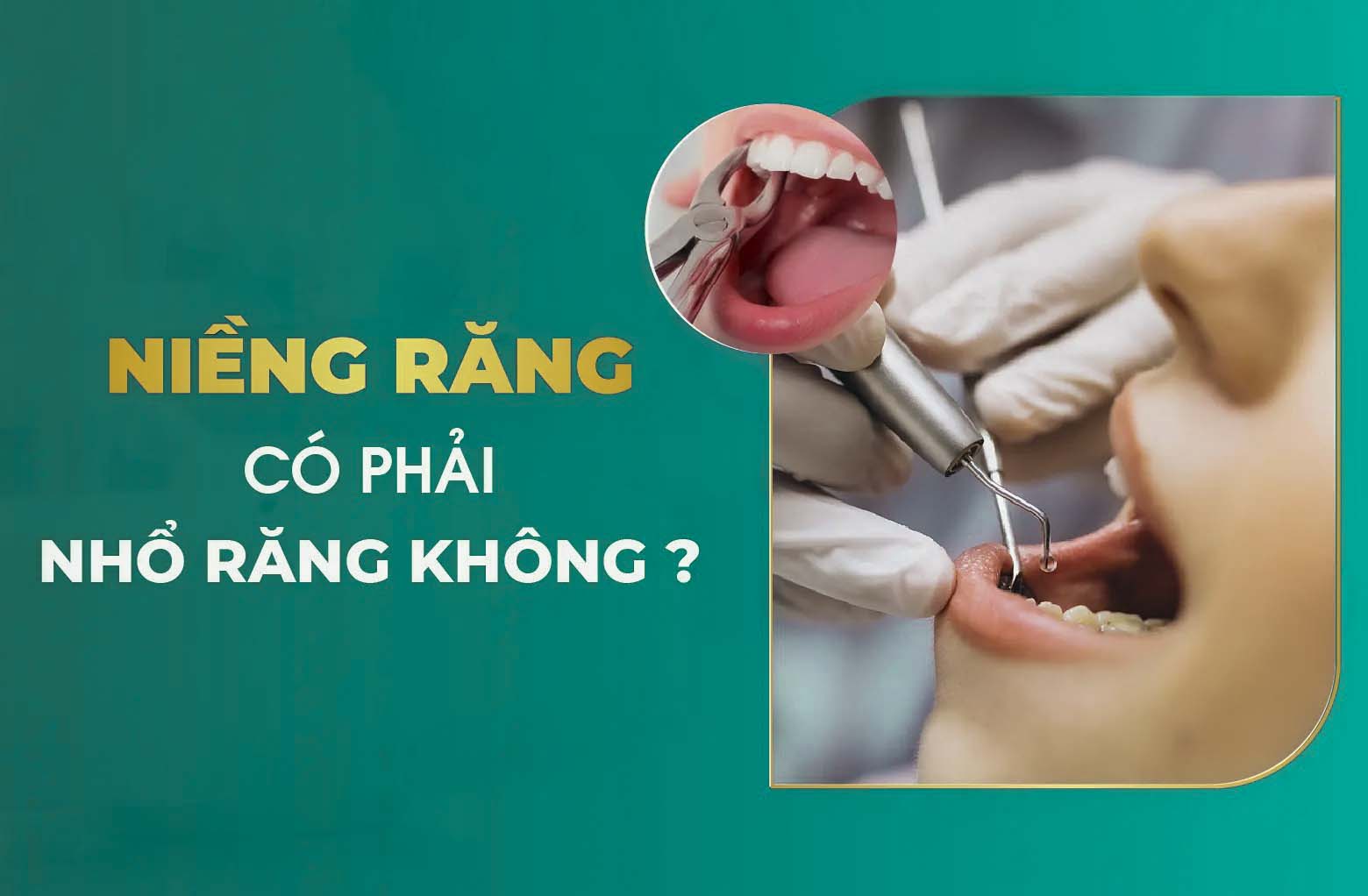 Niềng răng có phải nhổ răng không