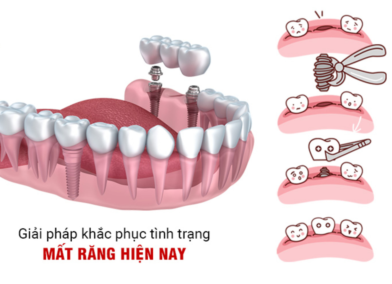 Phương pháp trồng răng implant hiện đại nhất hiện nay