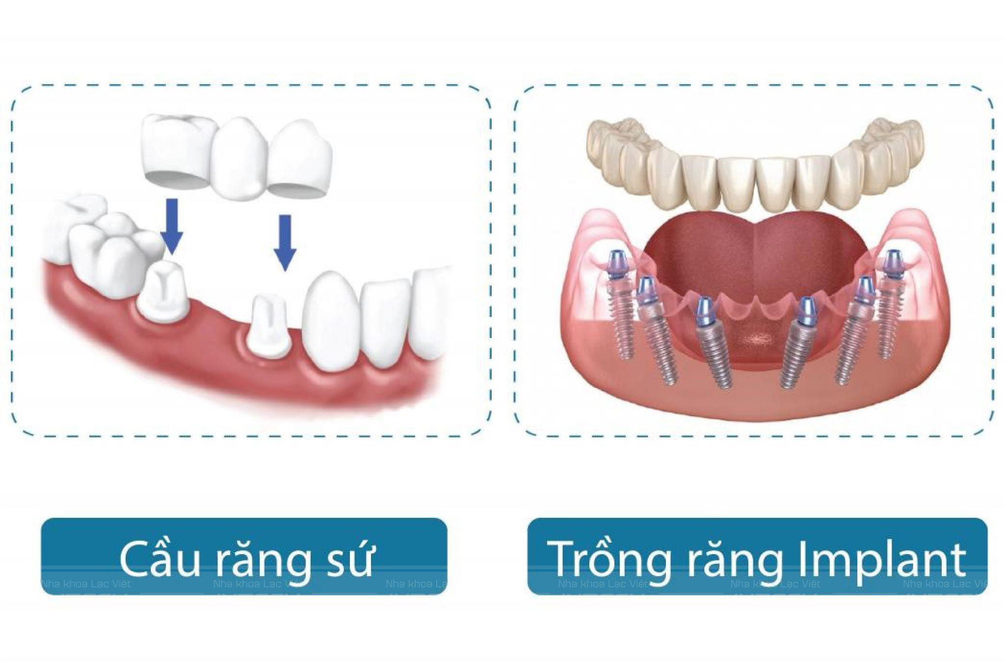 Răng sứ hay răng Implant