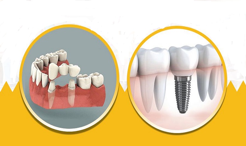 Nên bọc răng sứ hay trồng răng Implant