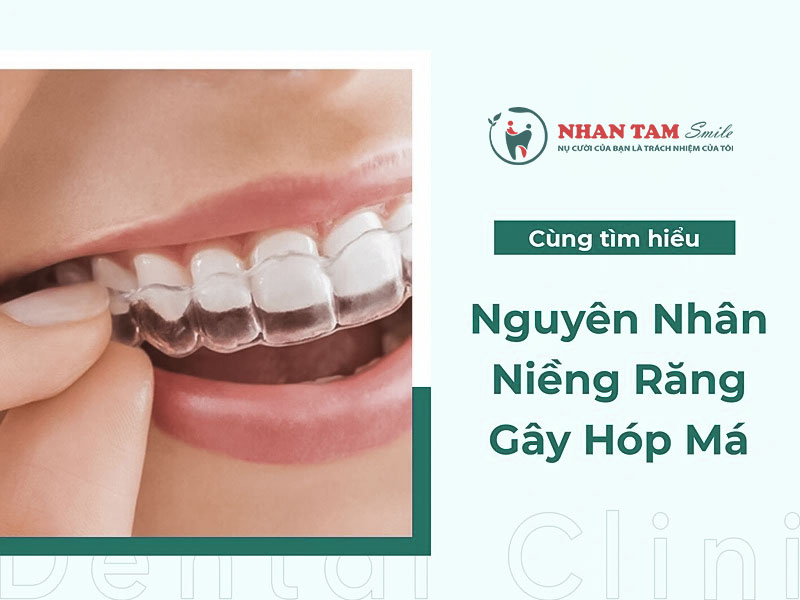 Niềng răng gây hóp má