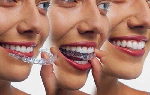 Niềng răng invisalign