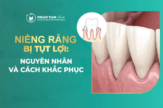 Niềng răng bị tụt lợi