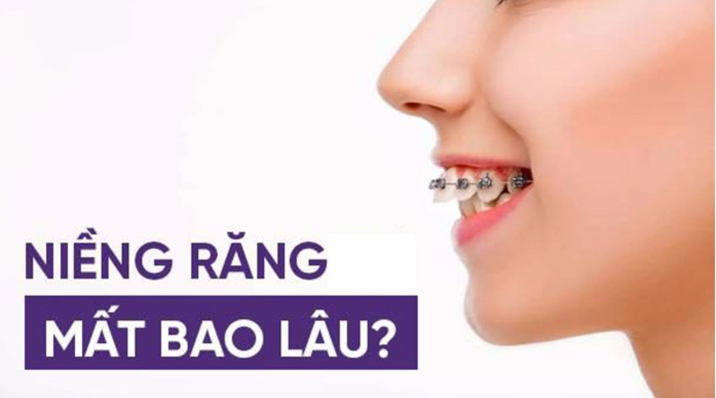 Thời gian niềng răng mất bao lâu?