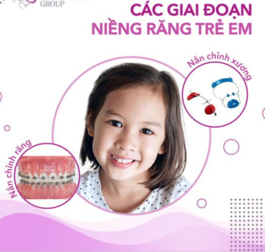 Các giai đoạn niềng răgn trẻ em