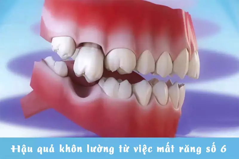 Hậu quả nghiêm trọng khi mất răng số 6