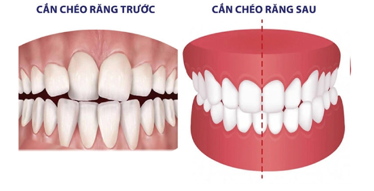 Khớp cắn chéo trước và khớp căn chéo sau