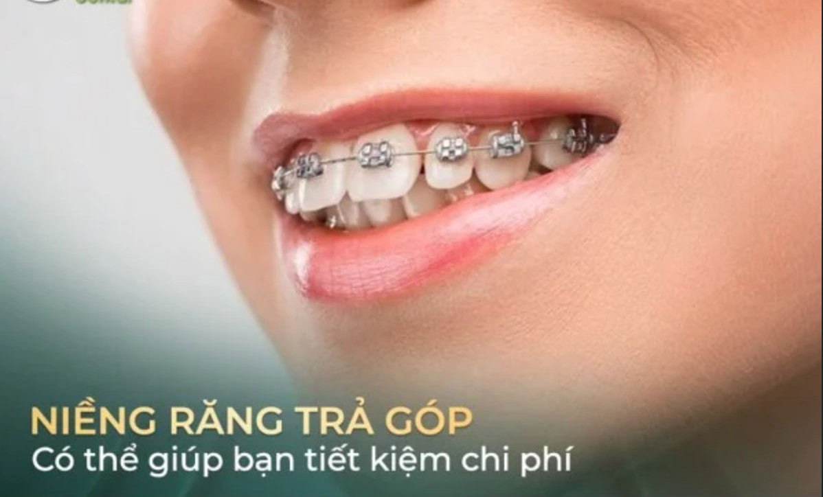 Các tuỳ chọn trả góp cho niềng răng giúp tiết kiệm chi phí