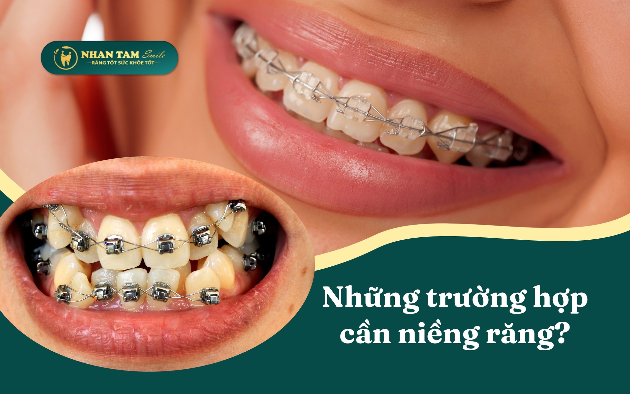 Những trường hợp cần niềng răng