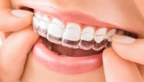 Niềng răng invisalign