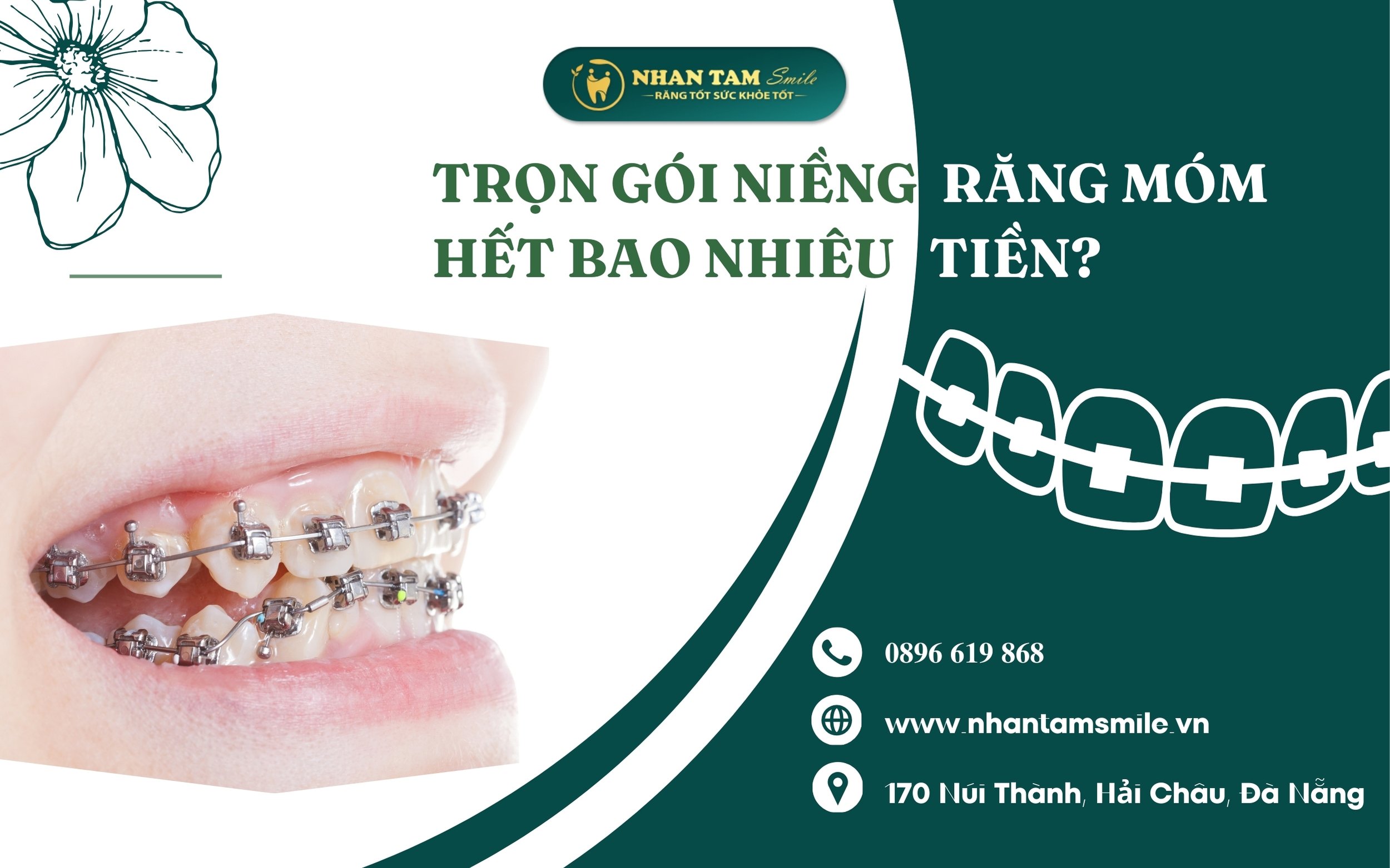 Niềng răng móm trọn gói