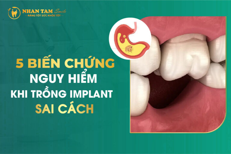 Biến chứng khi trồng Implant sai cách