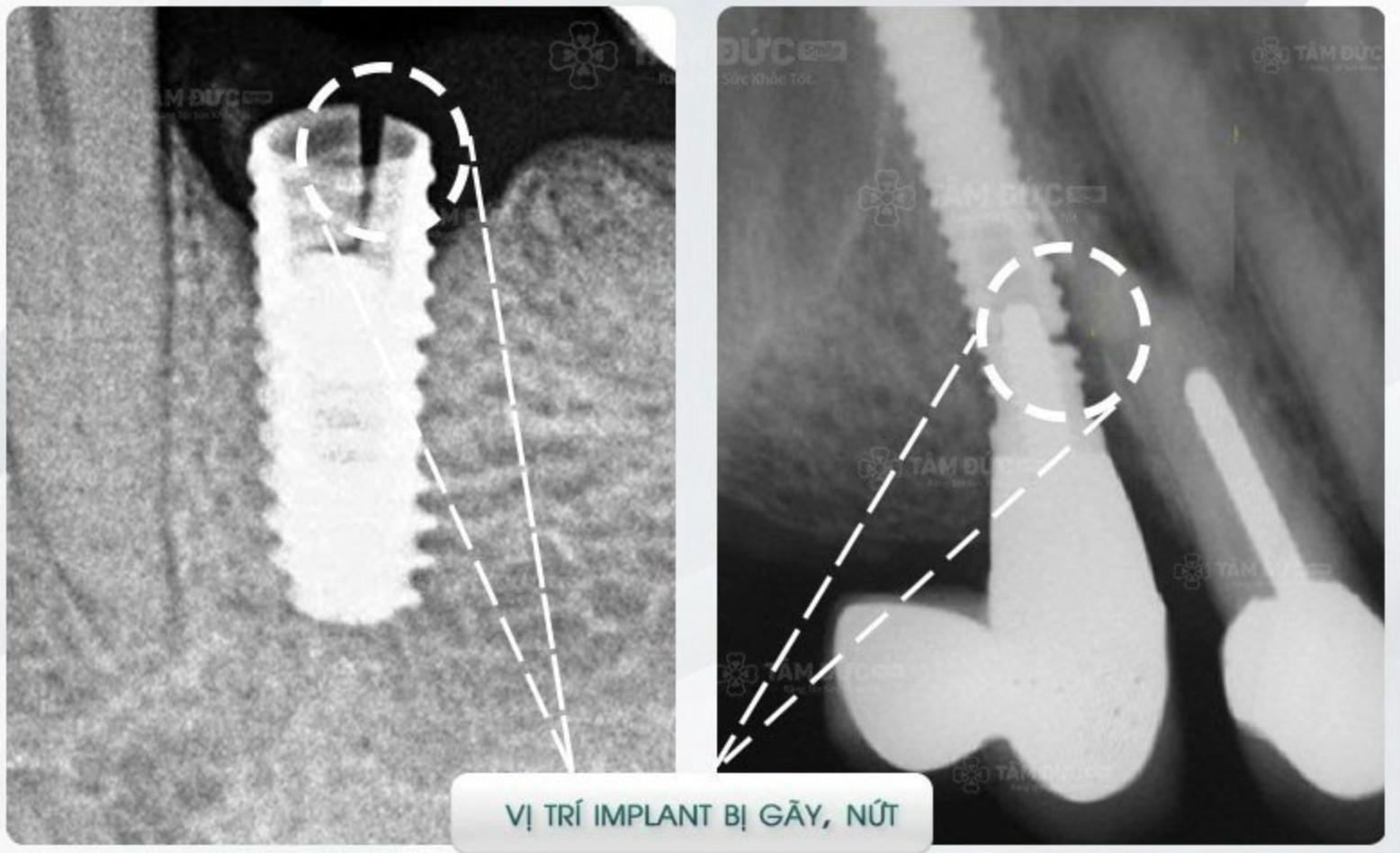 Cắm sai vị trí, gãy xương hàm nếu cấy Implant sai cách