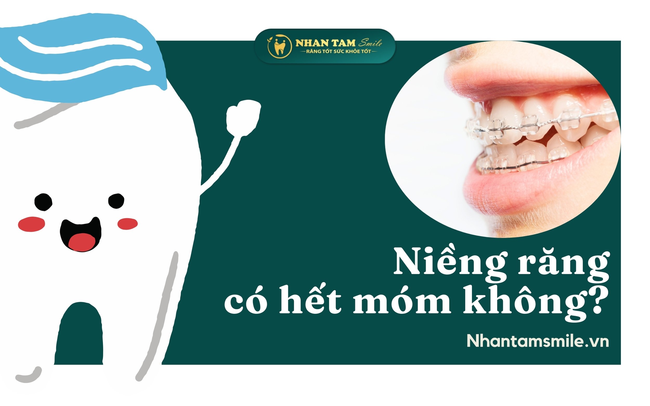 Niềng răng có hết móm không