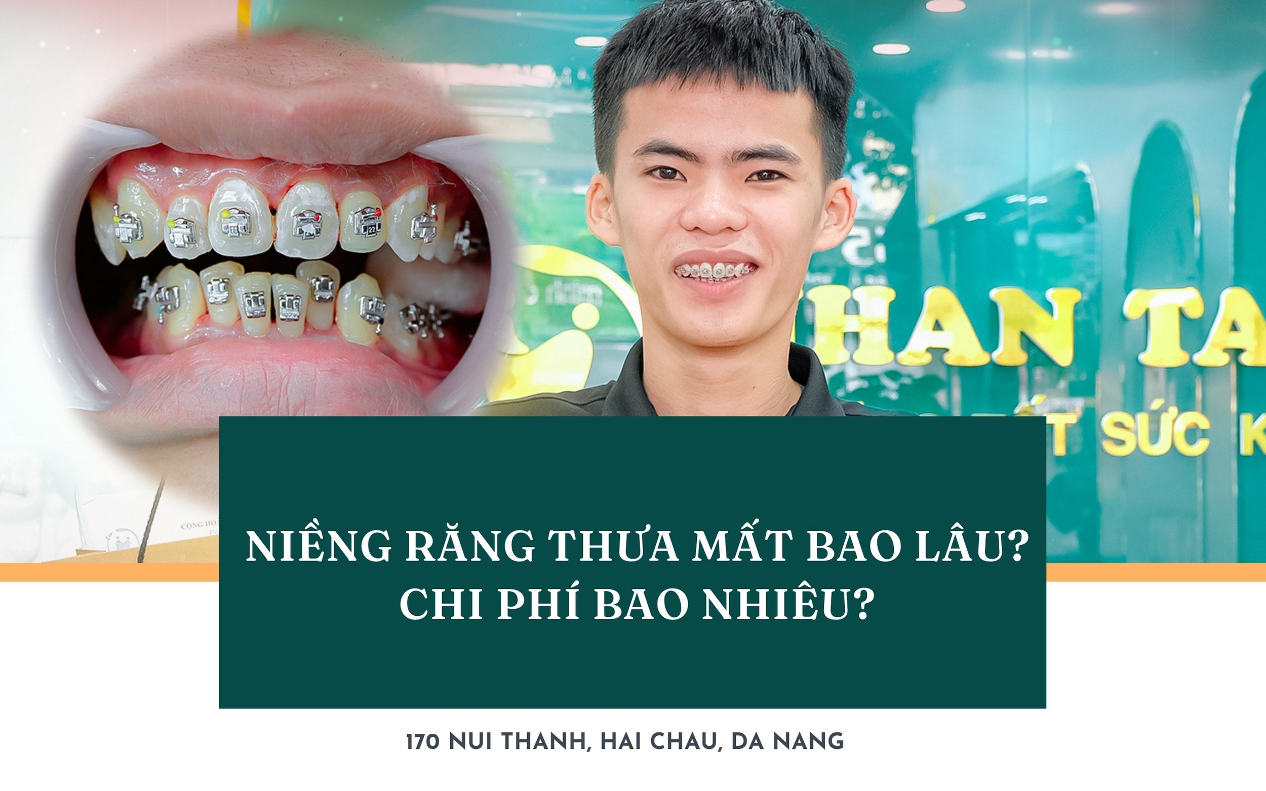 niềng răng thưa