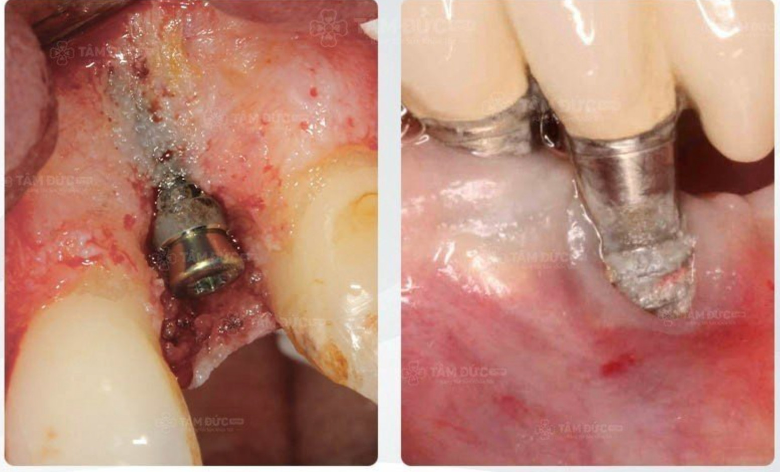 tổn thương mô lân cận khi cấy Implant rẻ và sai cách