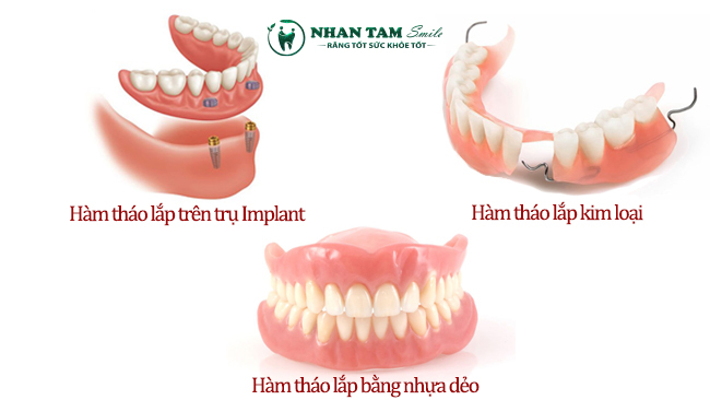 3 loại hàm giả tháo lắp phổ biến