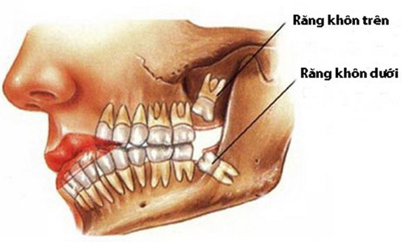 Răng khôn thường có hai cái nằm ở hàm trên và hàm dưới