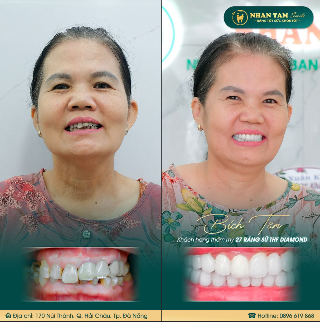 Trước và sau khi bọc răng sứ tại Nhan Tam Smile