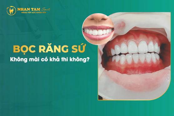 bọc răng sứ không mài có khả thi không_