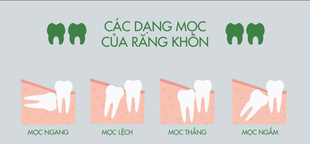 Các hình dạng mọc răng khôn