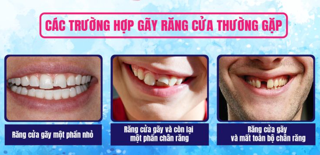 các trường hợp gãy răng cửa