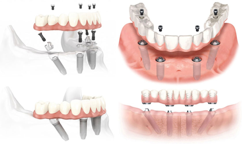 hàm giả tháo lắp trên trụ Implant