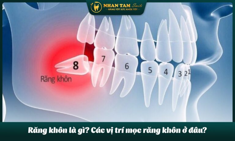 răng khôn là gì?