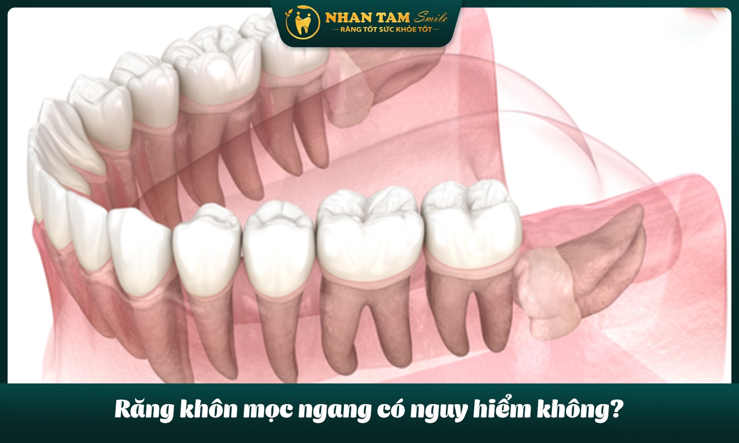 răng khôn mọc ngang có nguy hiểm không