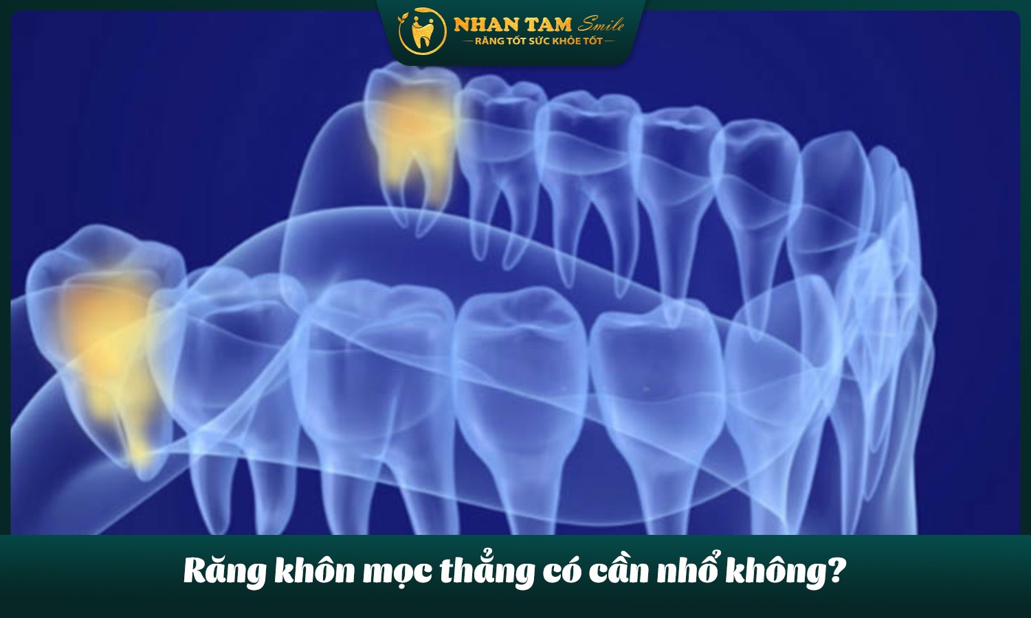 răng khôn mọc thẳng