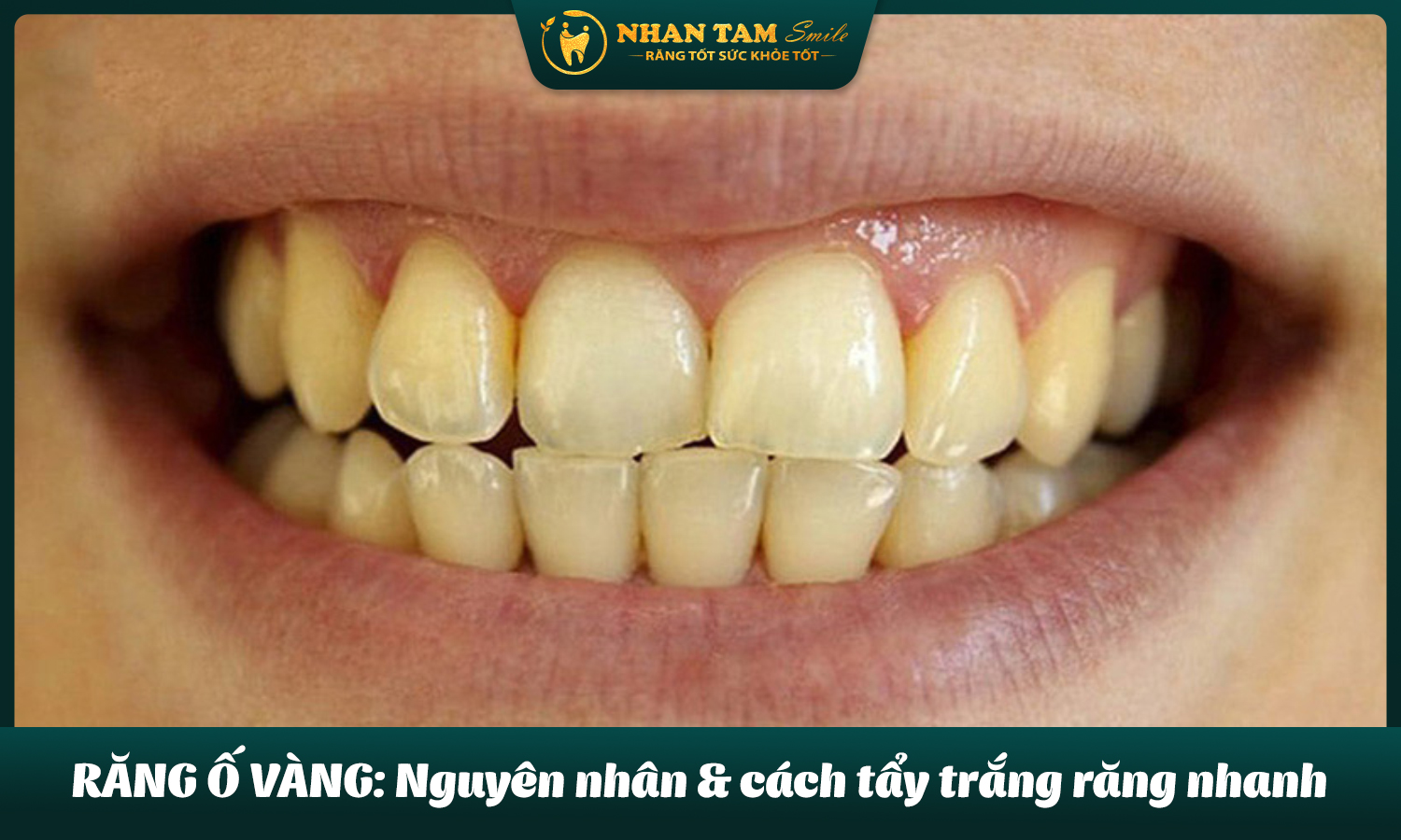 Răng ố vàng: Nguyên nhân và cách tẩy trắng răng nhanh