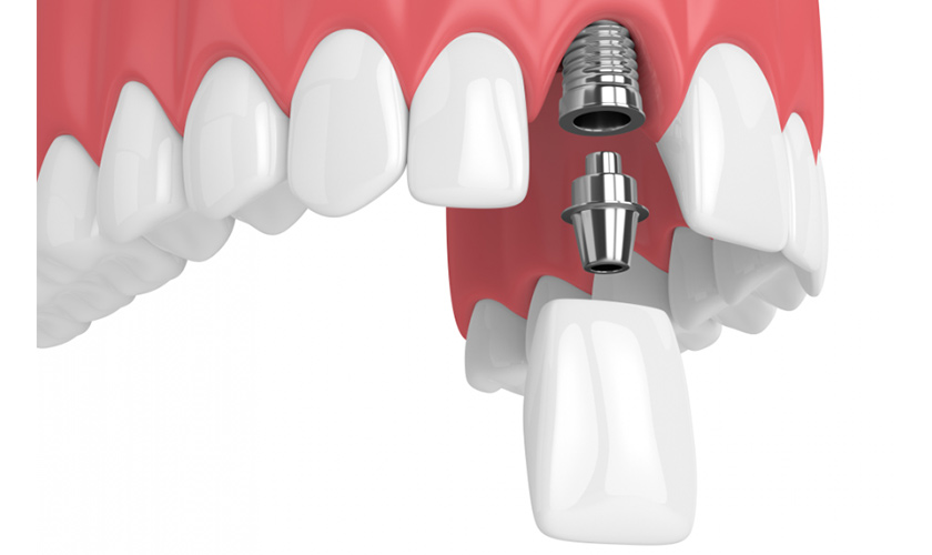 Trồng Implant cho răng cửa